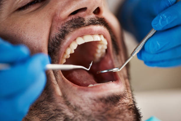 Best Emergency Treatment for Dental Infections or Abscesses in Rock Hill, NY